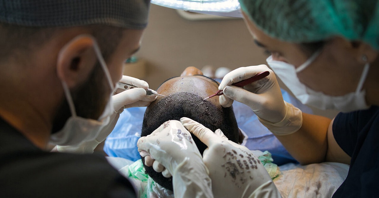 Turcja - Destynacja numer Jeden dla przeszczepów włosów! Odkryj tajemnicę sukcesu
